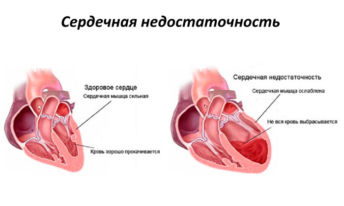 Здоровое сердце и сердце с ХСН