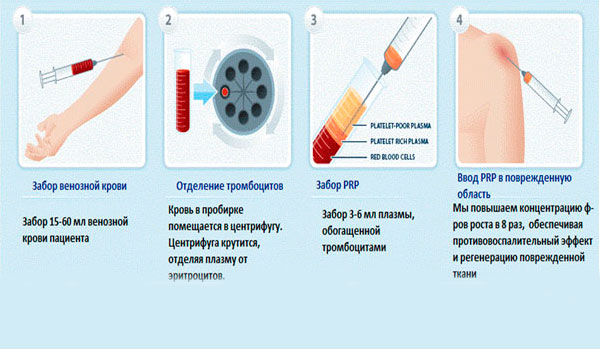 Методика PRP терапии