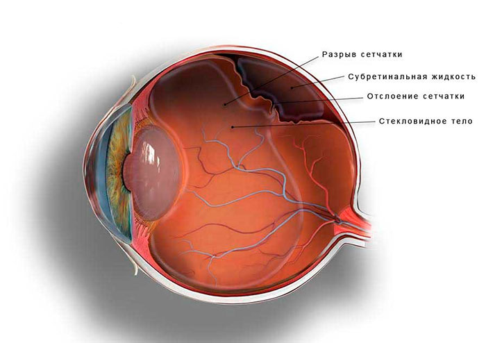 Отслоение сетчатки - в разрезе глазного яблока