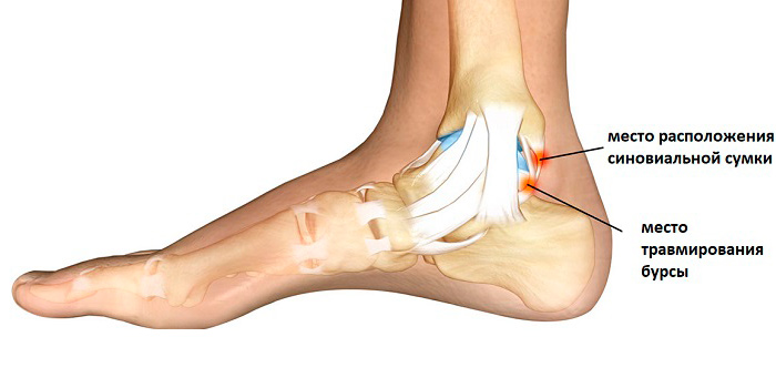 Схема образования ахиллобурсита