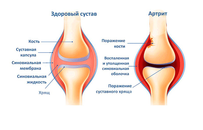 Развитие инфекционного артрита суставов